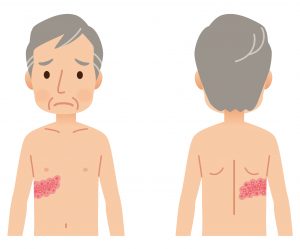 image of shingles rash on back and chest
